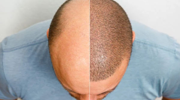 Hair Transplant