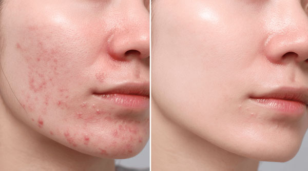 Laser Skin Treatments