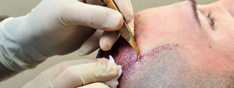 Hair Transplant Surgery with FUE Method