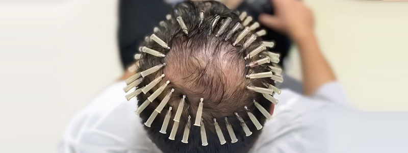Threadlift for Hair