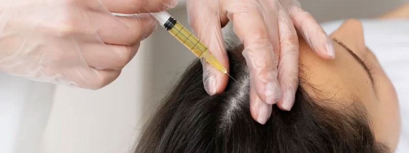 PRP Therapy for Hair