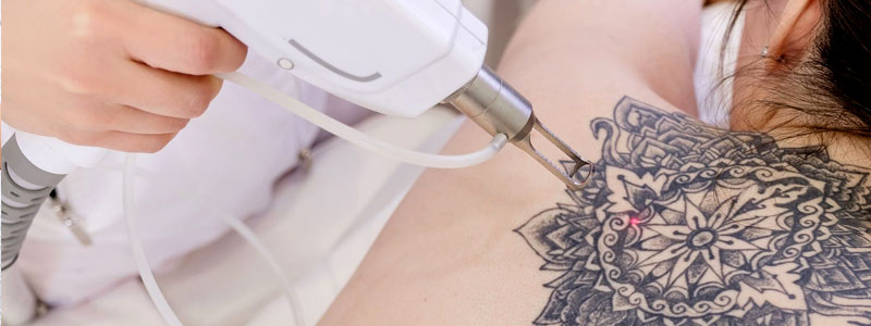 Tattoo Removal