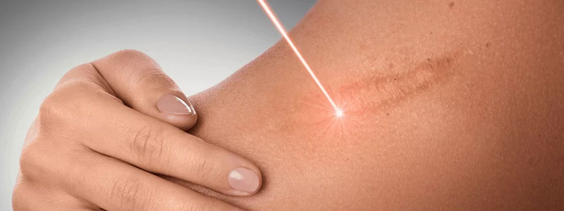 Laser Therapy for Scar Reduction