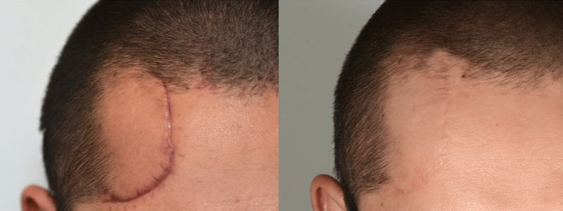 Scar Revision