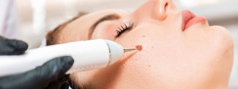 Mole Excision