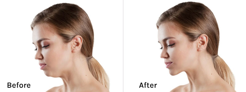 Jaw Surgery