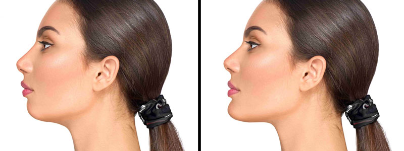 Chin Implants