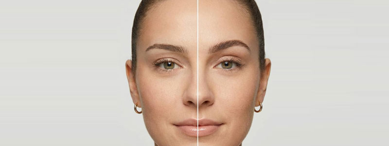 Eyebrow Lift