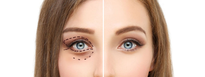 Eyelid Surgery (Blepharoplasty)