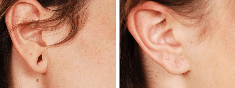 Earlobe Repair