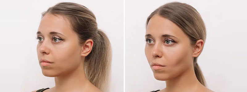 Buccal Fat Removal
