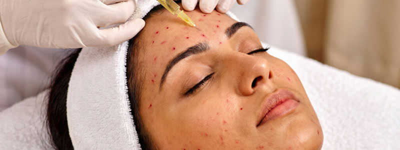 Vampire Facial